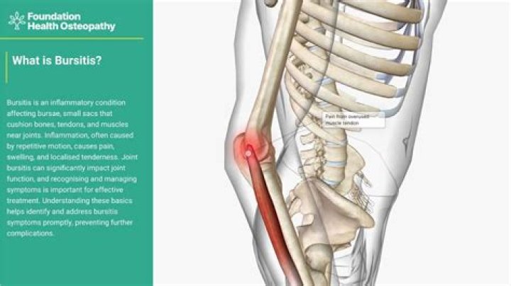 Is bursitis serious?