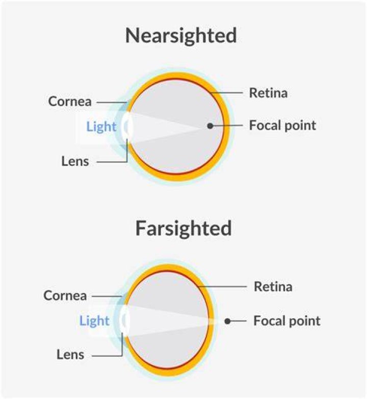 Is far sighted negative?