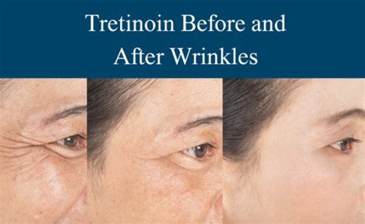 Is fennel good for wrinkles?