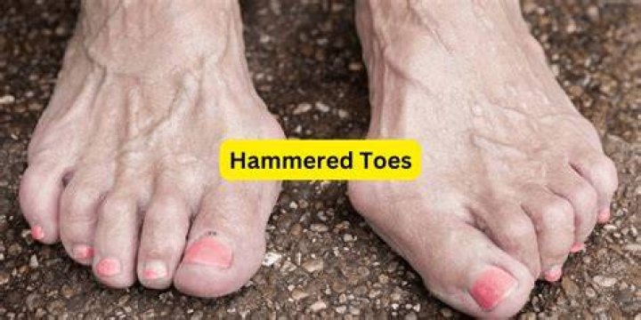 Is hammer toe painful?