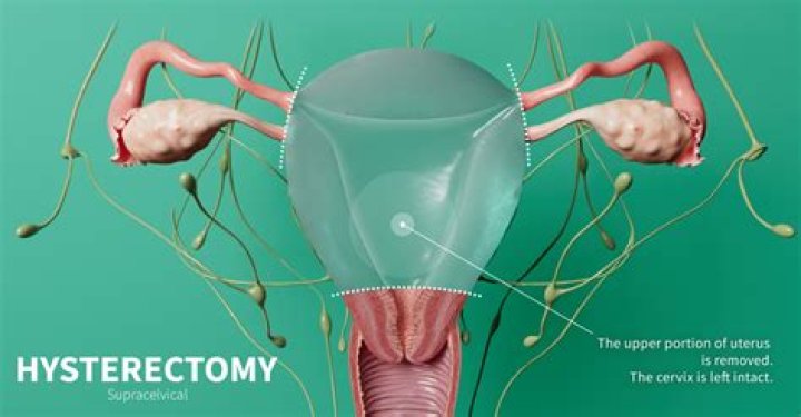 Is hysterectomy covered by Magna Carta?
