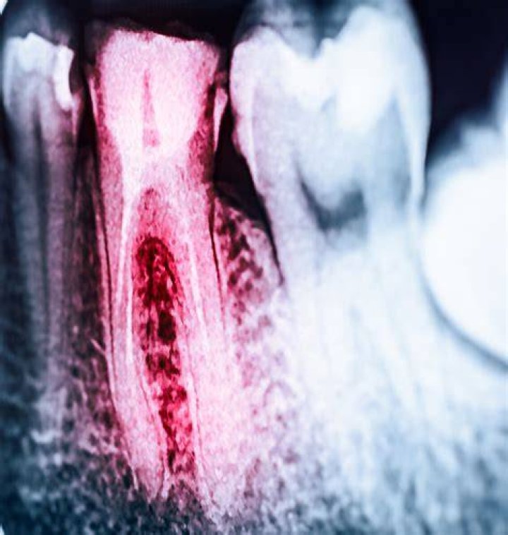 Is it better to get a root canal or tooth extraction?