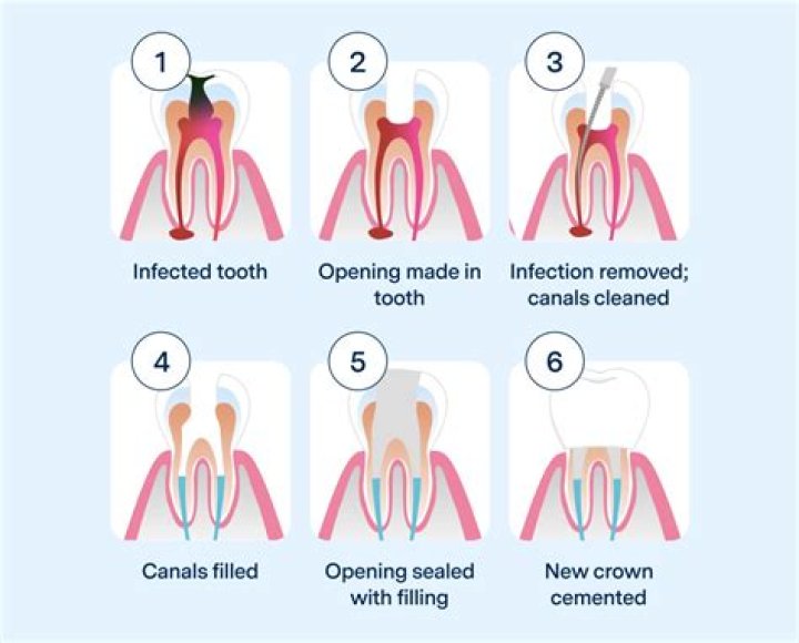 Is it common for a root canal to fail?