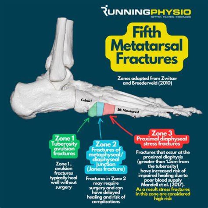 Is it easy to break your 5th metatarsal?