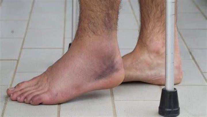 Is Matt Corral ankle broken?