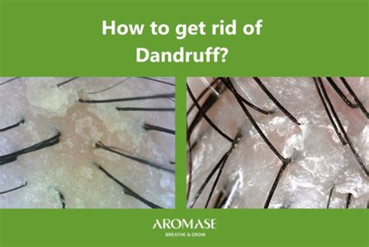 Is Methi good for dandruff?
