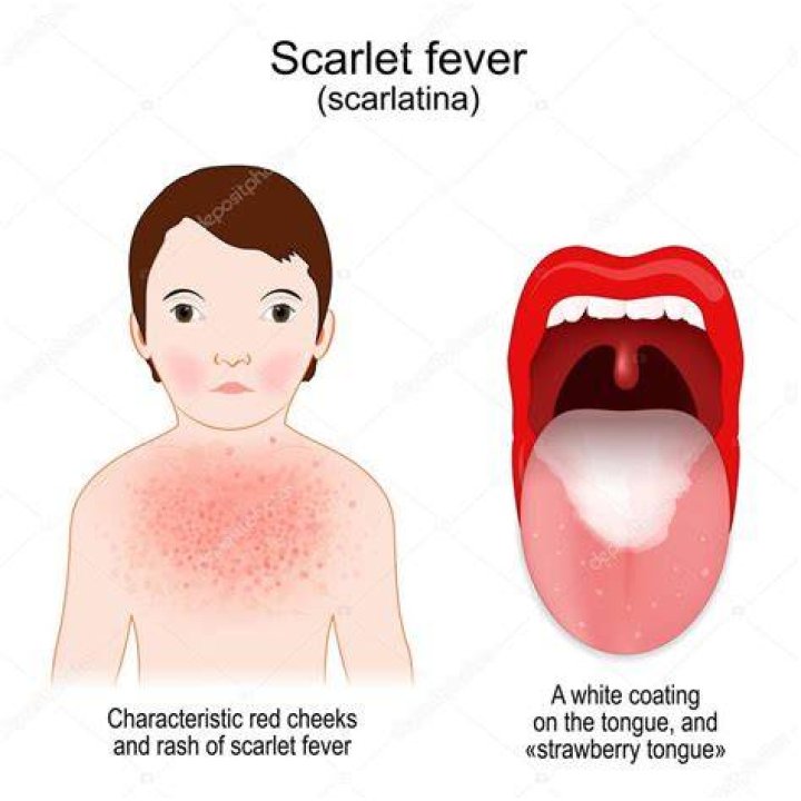 Is Mud fever the same as scratches?