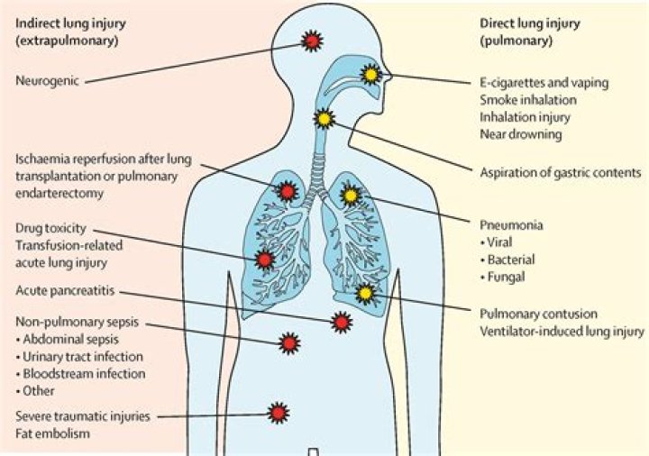 Is respiratory failure curable?