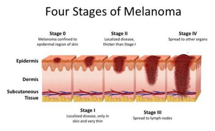 Is Stage 1 melanoma serious?