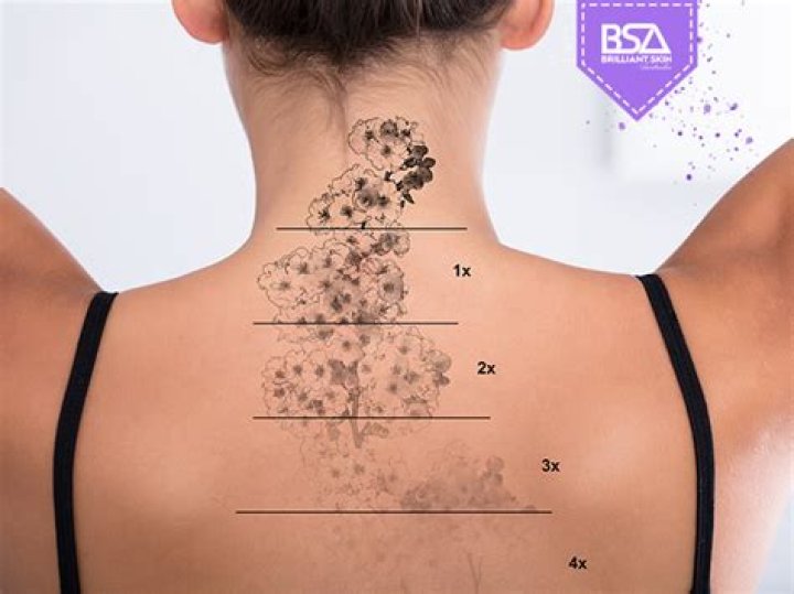 Is tattoo removal painful?