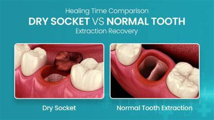 Is there a difference between getting a tooth pulled and extracted?