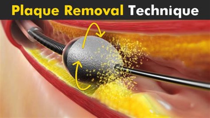 Is there a way to remove plaque from your brain?