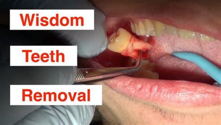 Is tooth removal painful?
