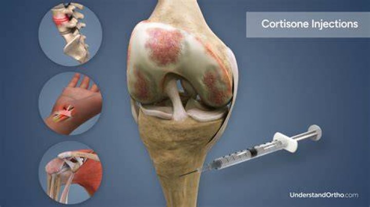 Should I get a cortisone shot in my heel?