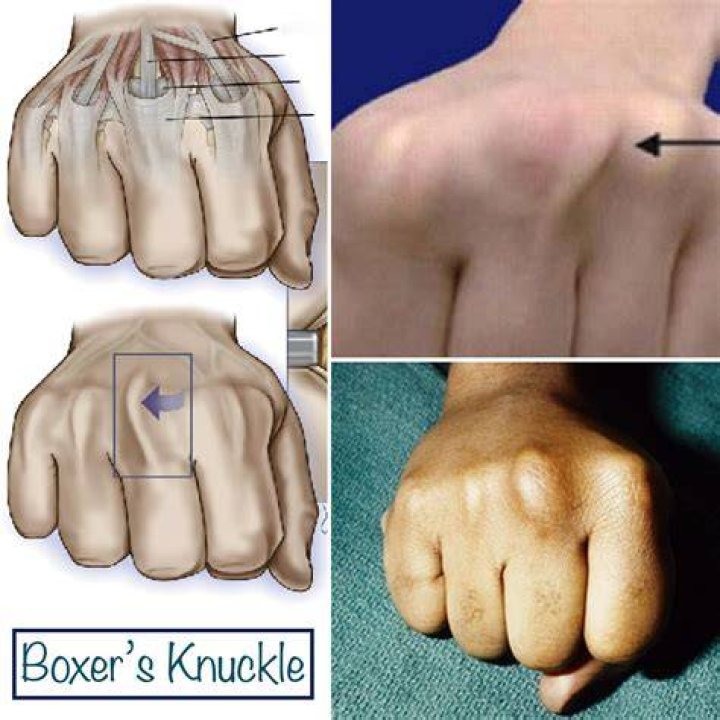 Should your fingers hurt after boxing?