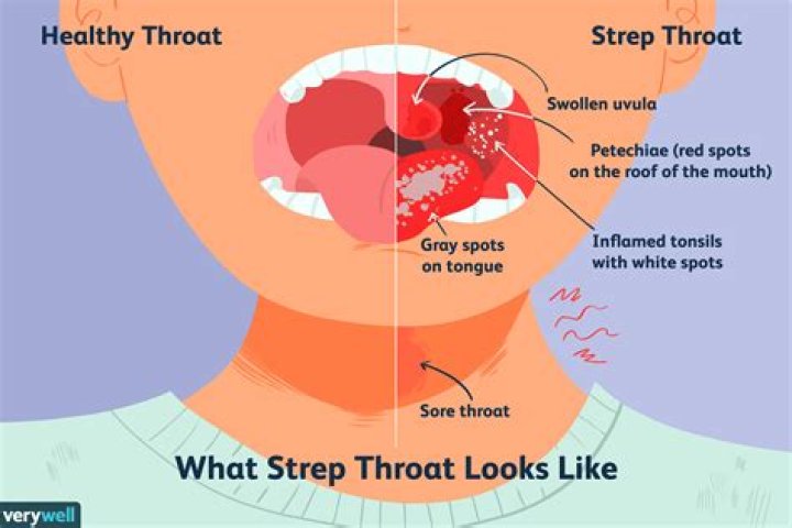 What's strep throat look like?
