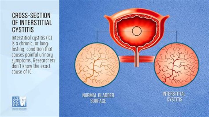What aggravates interstitial cystitis?
