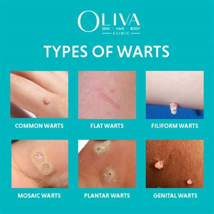 What are bumps that look like warts?