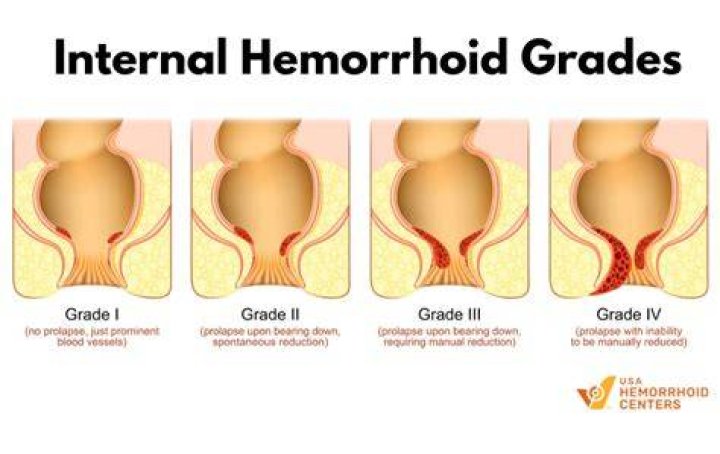 What are Grade 4 hemorrhoids?