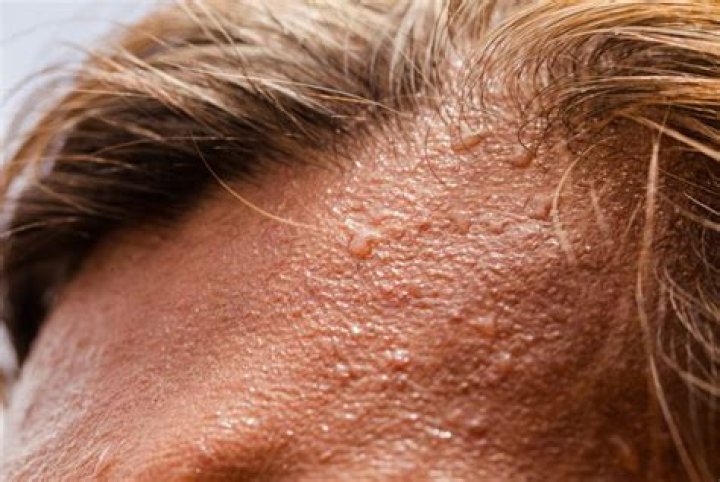 What are lymphoma night sweats like?