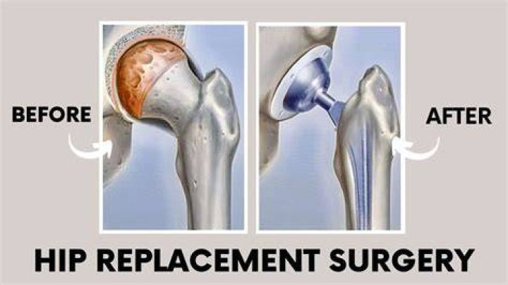 What are the 2 types of hip replacement surgery?