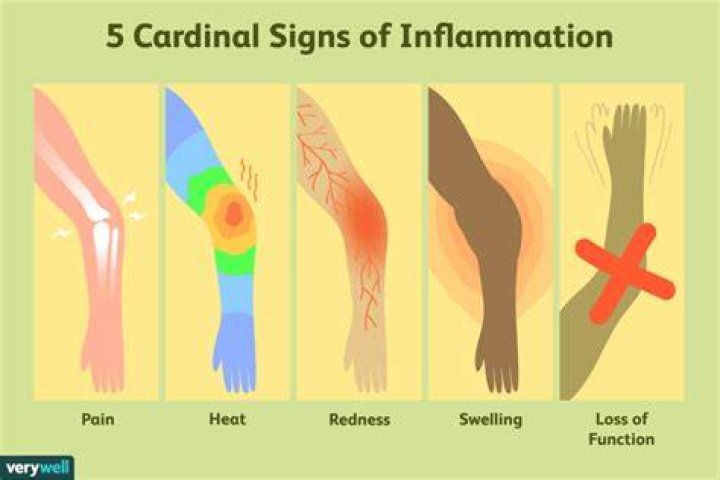 What are the 4 main signs of inflammation?