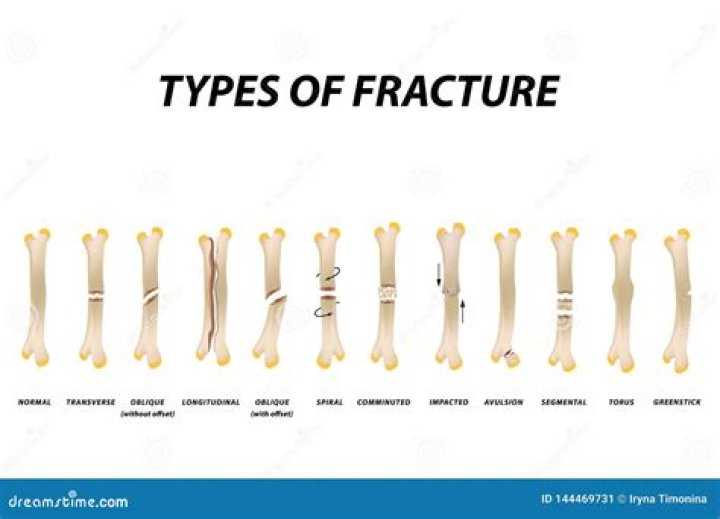 What are the 7 types of fractures?
