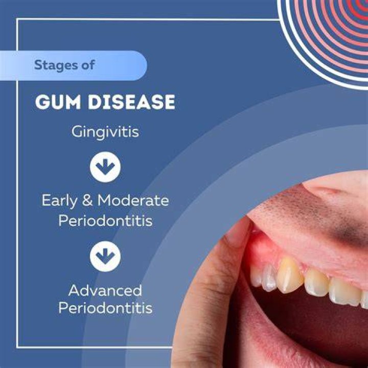 What are the stages of gingivitis?