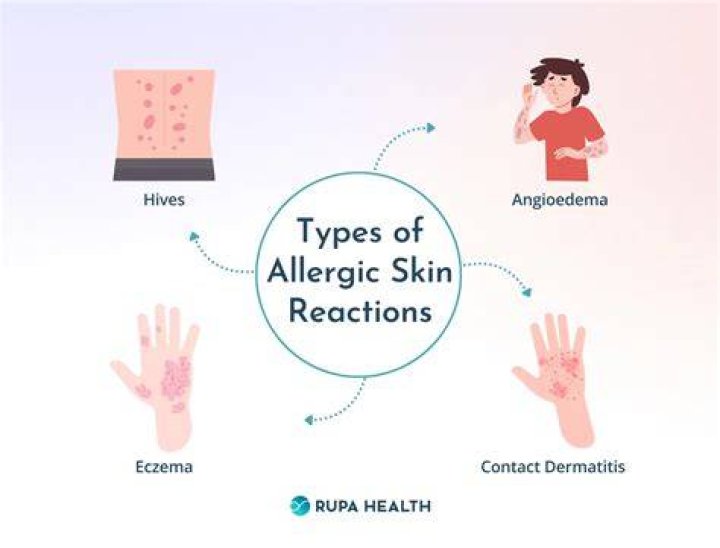 What are the symptoms of an allergic reaction to soap?