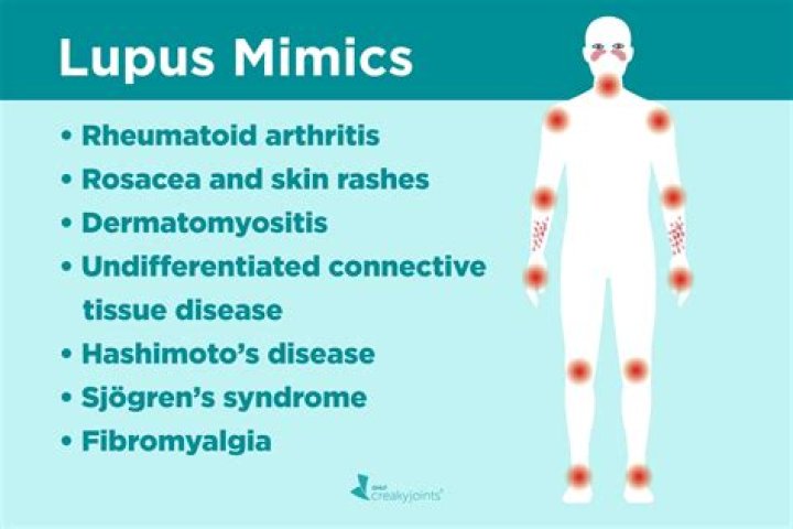 What are the symptoms of lupus arthritis?