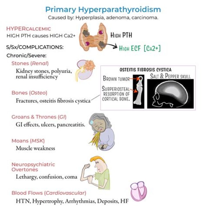 What autoimmune disease causes hyperparathyroidism?