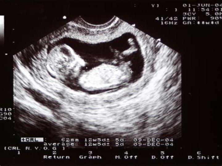What can ultrasound show 10 weeks?