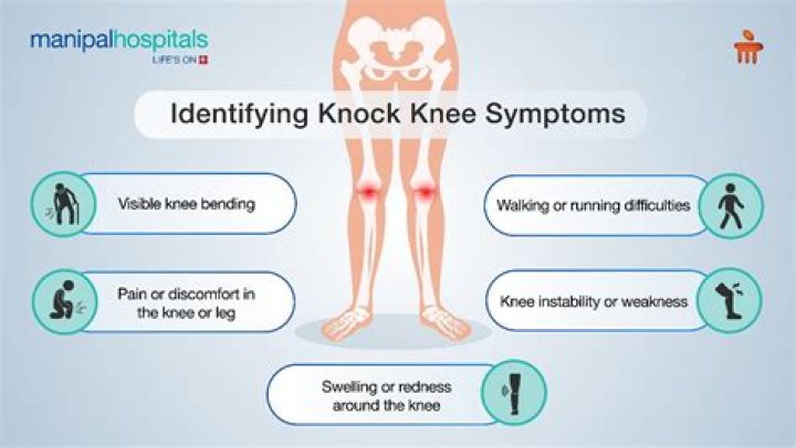 What causes a knock knee?