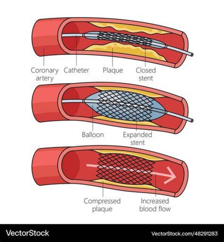 What causes a stent to fail?