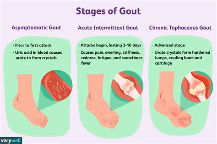 What causes gout in your foot?