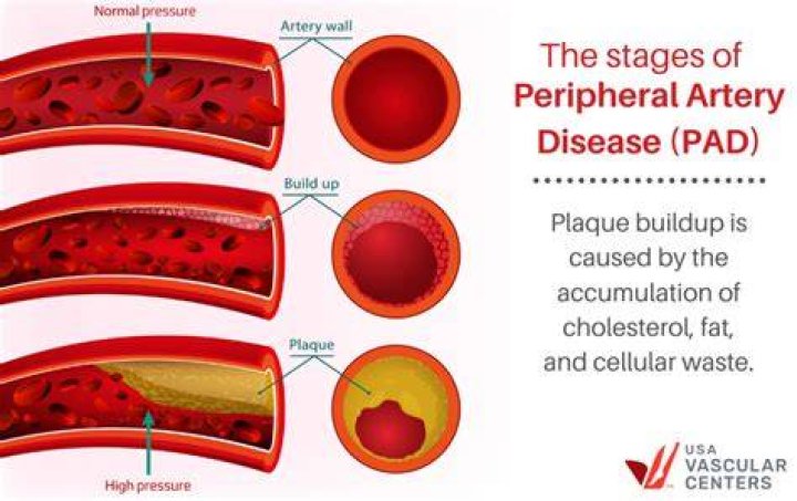 What causes plaque buildup in the brain?
