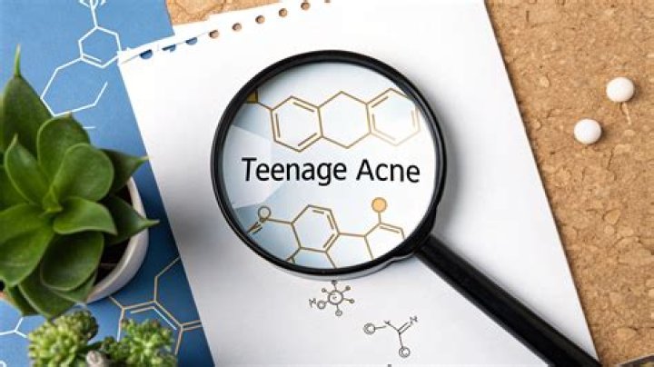 What causes teenage acne?