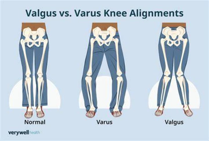 What causes valgus?