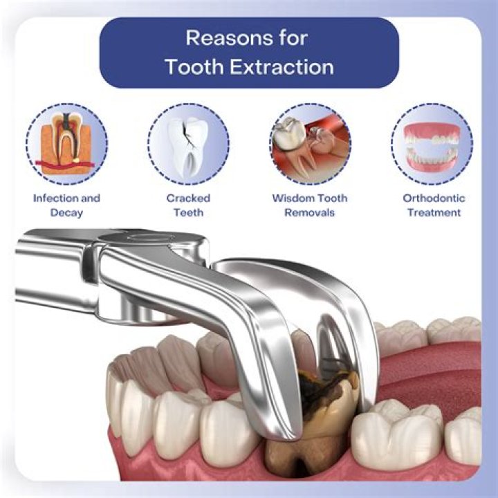 What do dentists use for extractions?