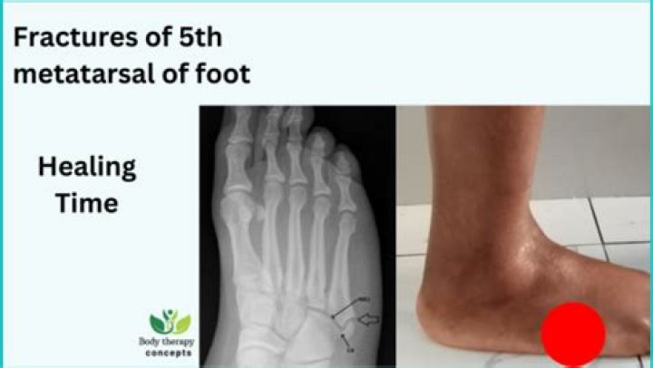 What does a 5th metatarsal fracture feel like?