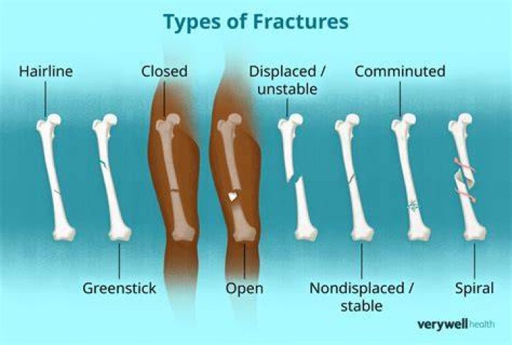 What does a hairline fracture femur feel like?