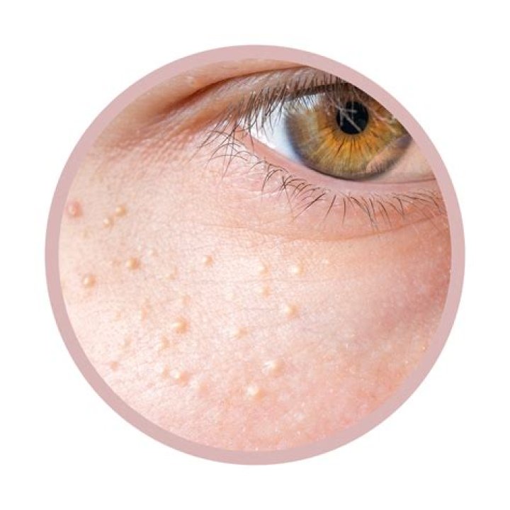 What does a milia look like?