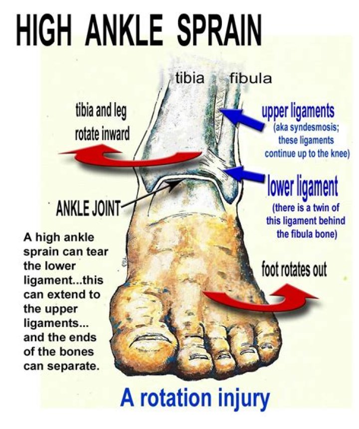 What does a sprained foot feel like?
