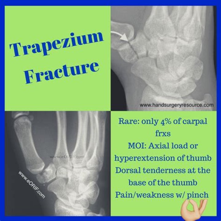 What does a trapezoid fracture feel like?
