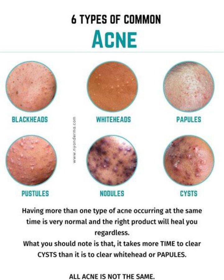 What does acne purging look like?