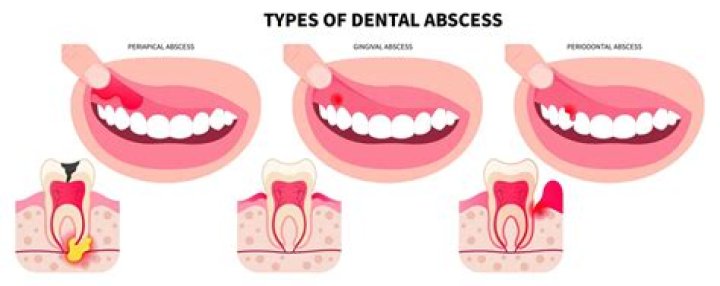 What does an abscess smell like?
