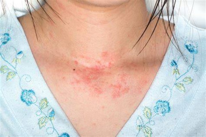 What does an allergy rash look like?