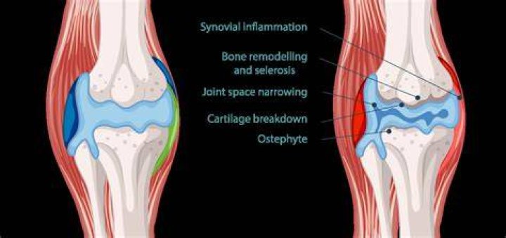 What does arthritis in elbow feel like?