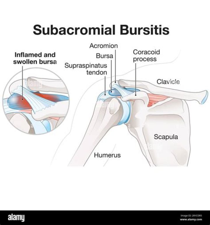 What does bursitis in the shoulder feel like?