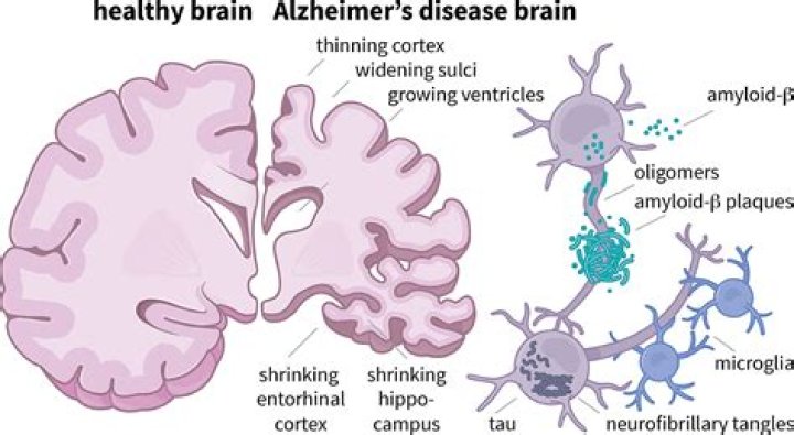 What does plaque on the brain indicate?